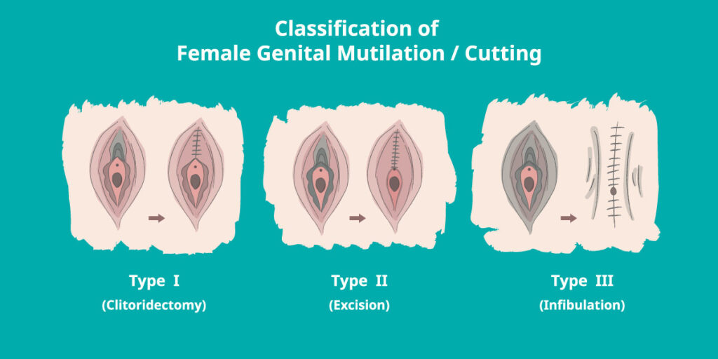 tipologie di mutilazioni femminili 